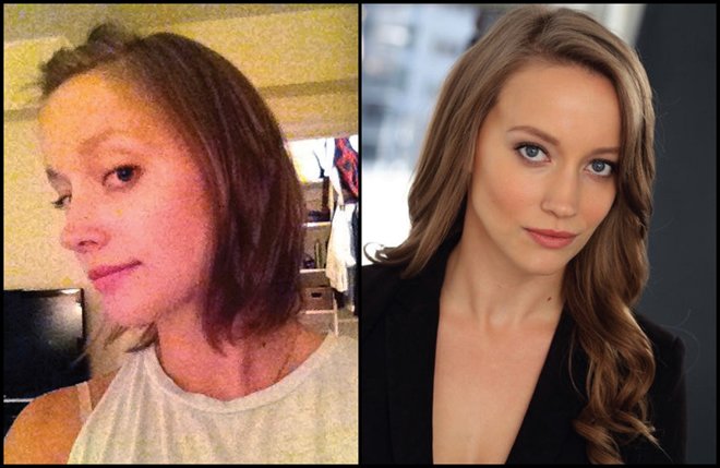 Female pattern baldness