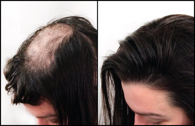 Trichotillomania