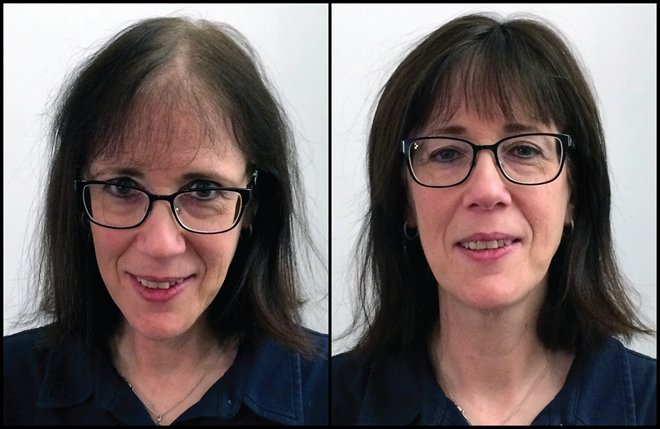 Androgenetic alopecia